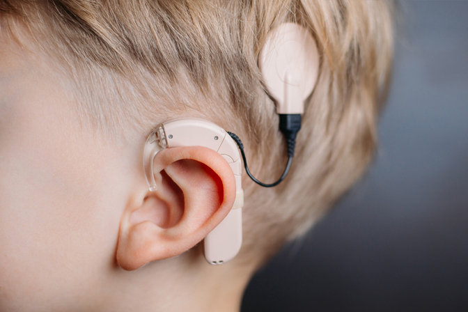 Cochlear Implant